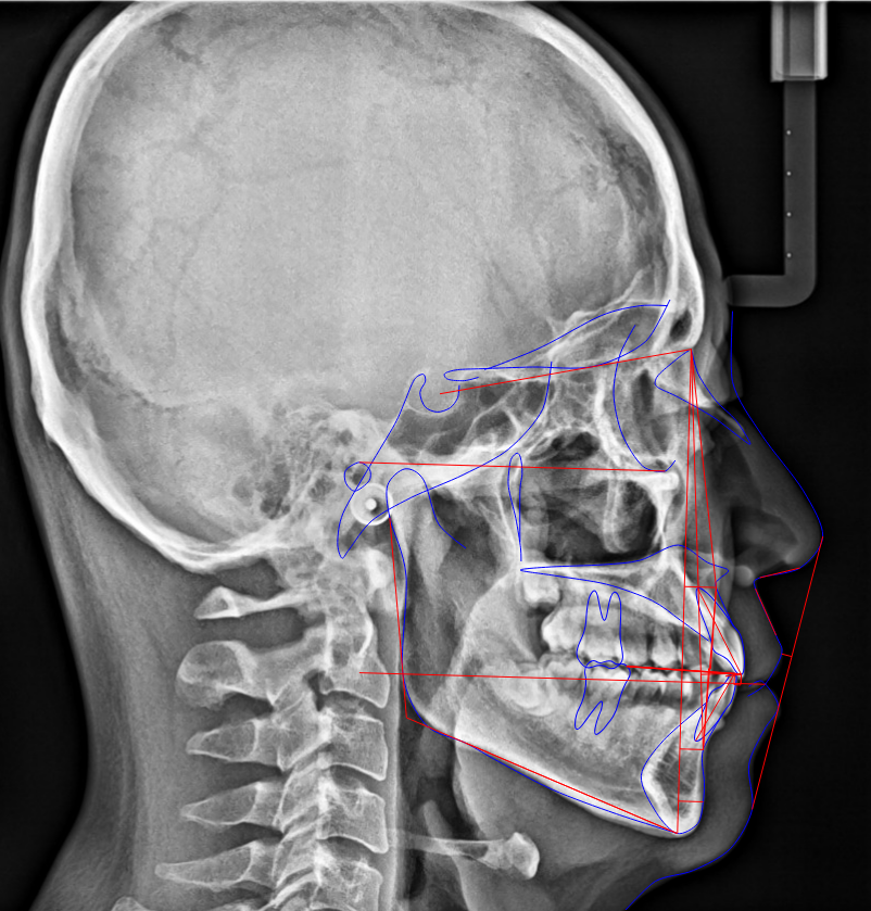セファロレントゲン