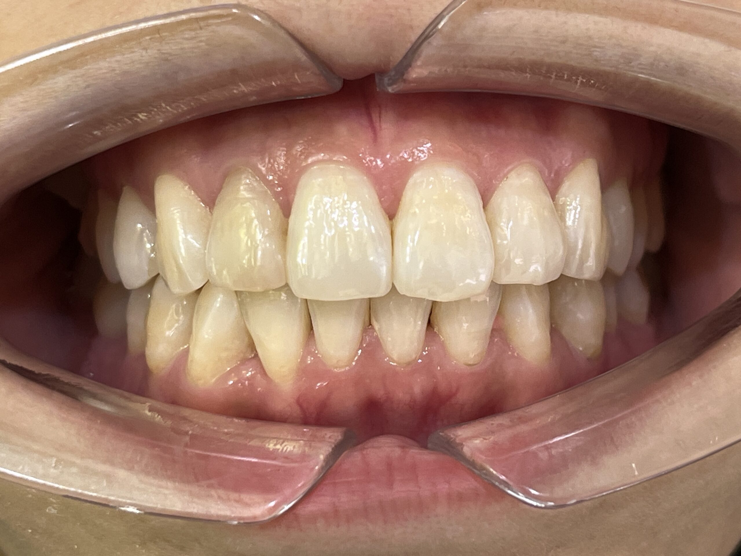 叢生 矯正 治療後