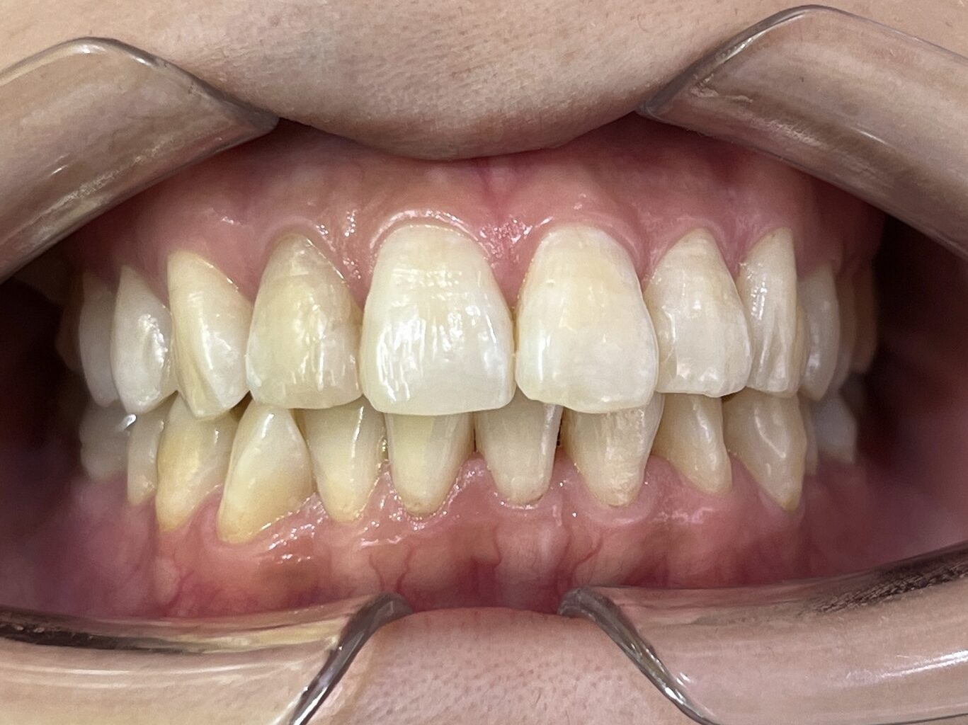 叢生 矯正 治療前