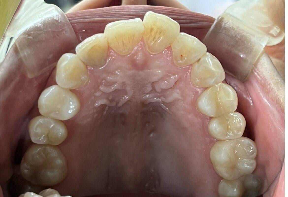 叢生 矯正 治療前