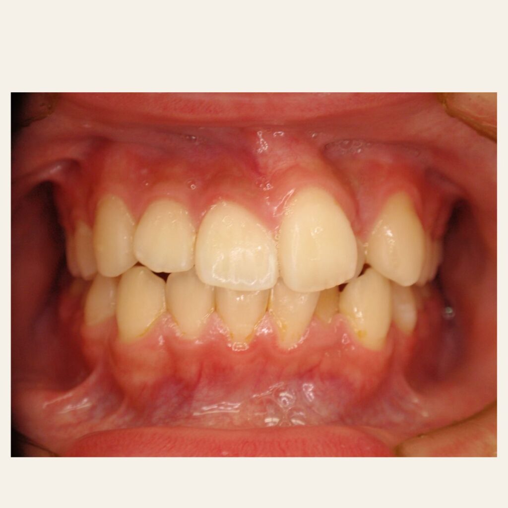 叢生 矯正 治療前