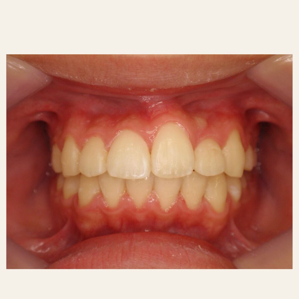 叢生 矯正 治療後