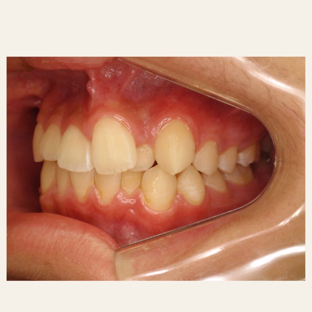 叢生 矯正 治療前