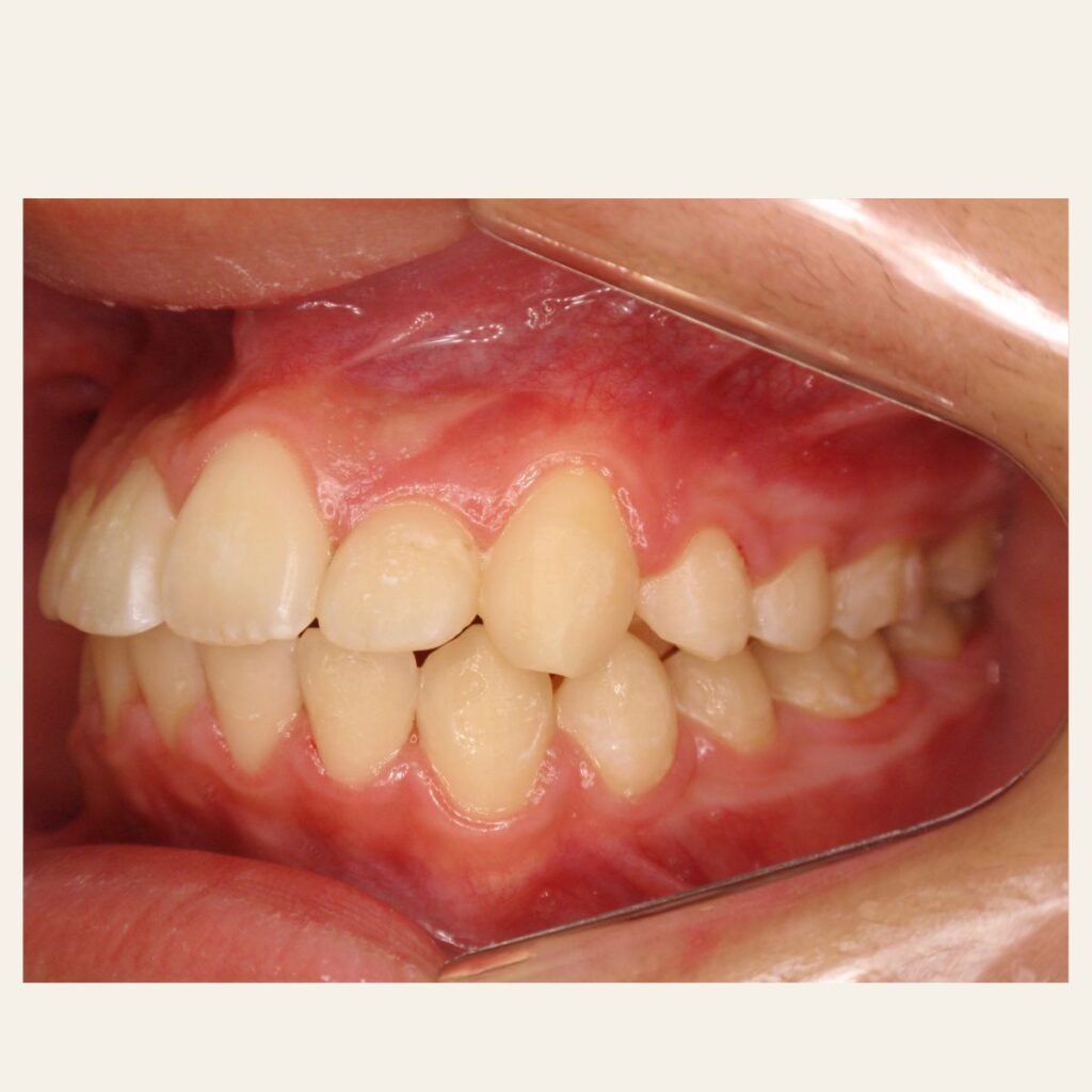 叢生 矯正 治療後