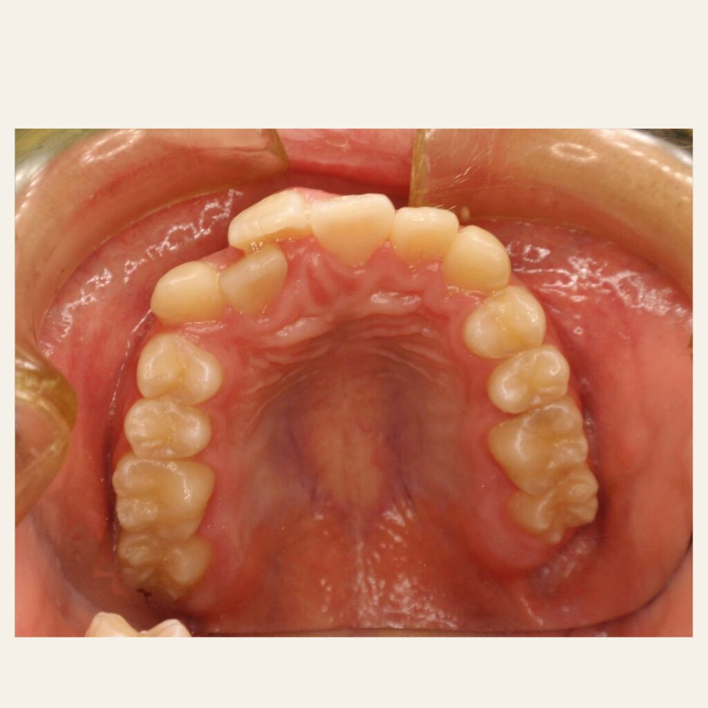 叢生 矯正 治療前