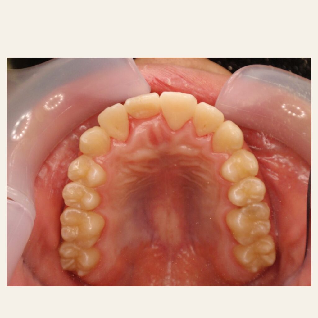 叢生 矯正 治療後