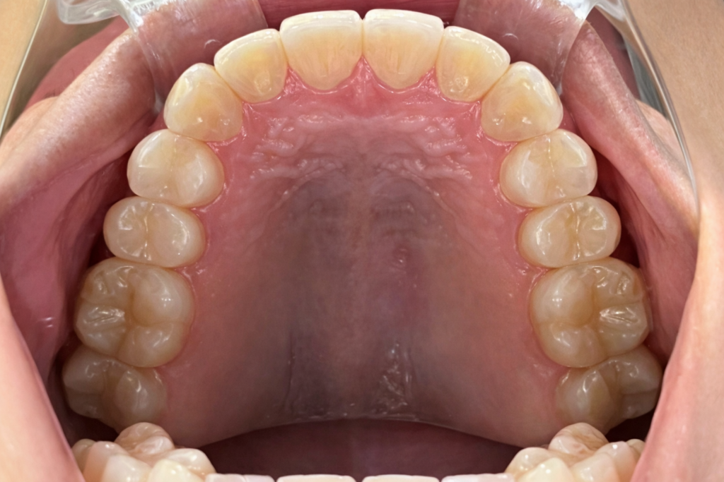 叢生 矯正 治療後